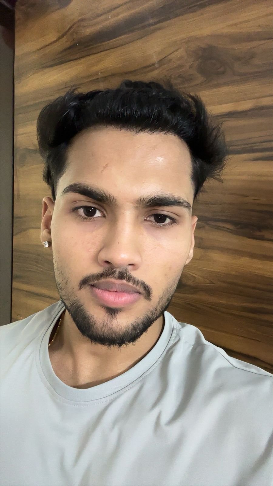 Patient After Hair Transplant